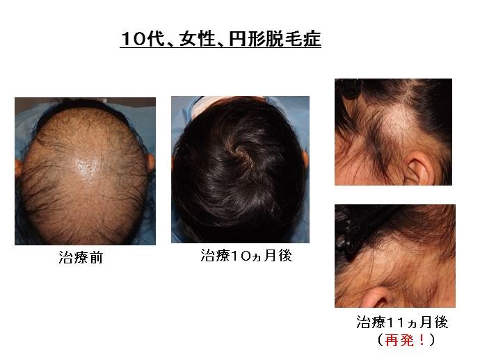 汎発性脱毛　病院""